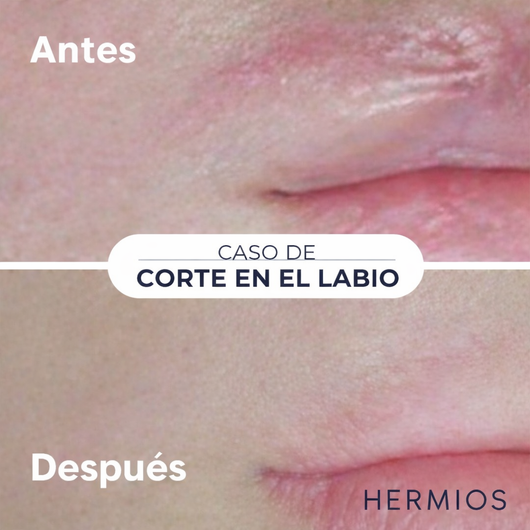 Hermios Spray para eliminar cicatrices