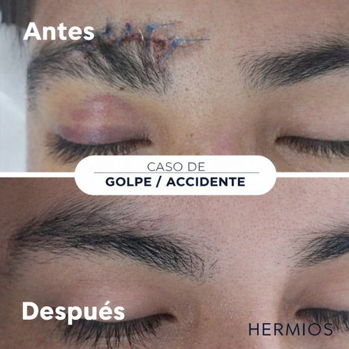 Hermios Spray para eliminar cicatrices