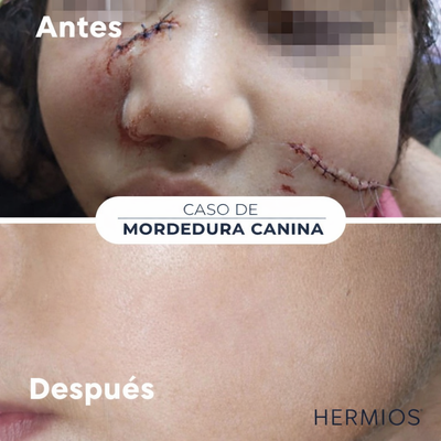 Hermios Spray para eliminar cicatrices