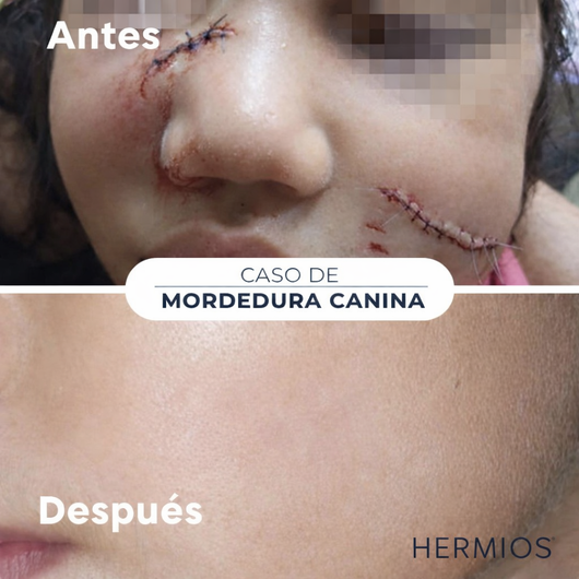 Hermios Spray para eliminar cicatrices