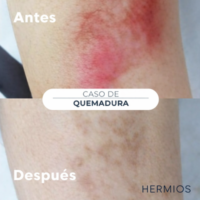 Hermios Spray para eliminar cicatrices